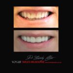 PORCELAIN-VENEERS-MAKEOVERS-MELBOURNE-48.jpg