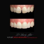 PORCELAIN-VENEERS-MAKEOVERS-MELBOURNE-54.jpg