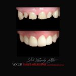 PORCELAIN-VENEERS-MAKEOVERS-MELBOURNE-55.jpg