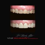 PORCELAIN-VENEERS-MAKEOVERS-MELBOURNE-57.jpg