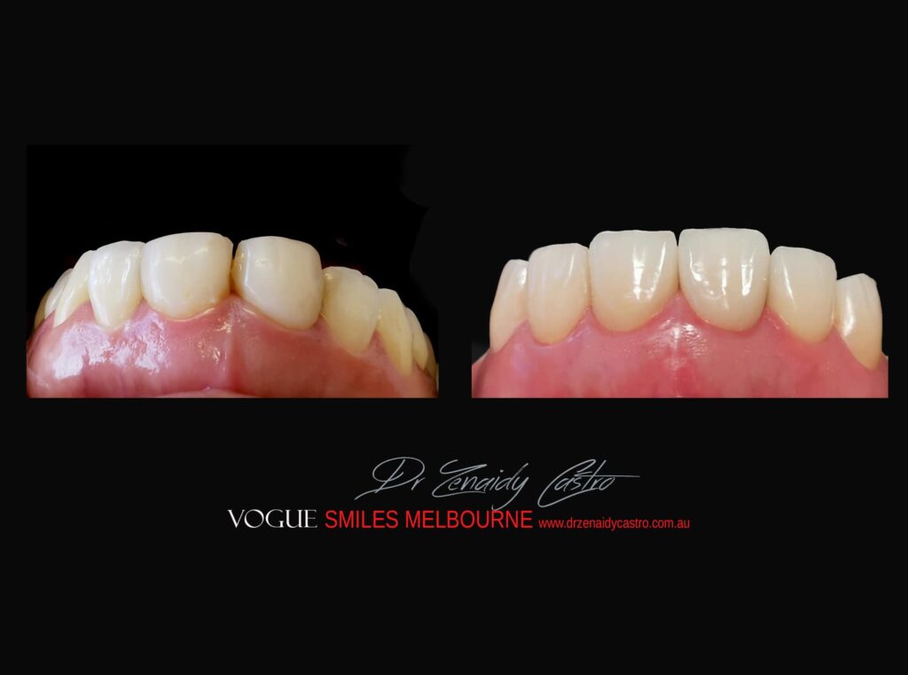 PORCELAIN-VENEERS-MAKEOVERS-MELBOURNE-6.jpg