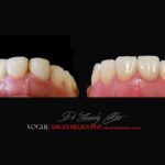 PORCELAIN-VENEERS-MAKEOVERS-MELBOURNE-6.jpg