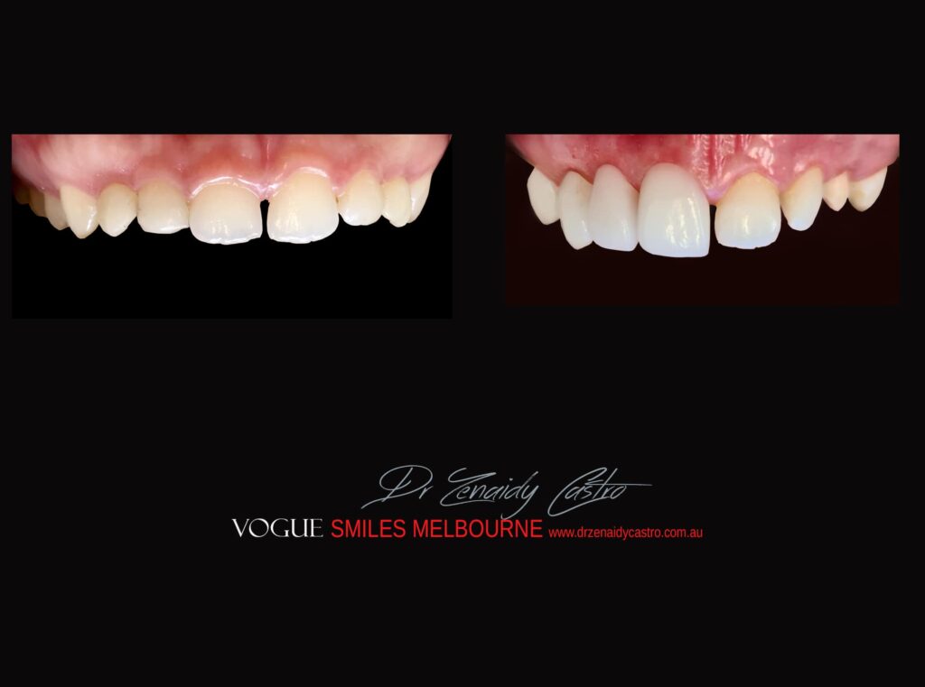 PORCELAIN-VENEERS-MAKEOVERS-MELBOURNE-60.jpg