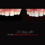 PORCELAIN-VENEERS-MAKEOVERS-MELBOURNE-60.jpg