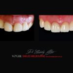 PORCELAIN-VENEERS-MAKEOVERS-MELBOURNE-62.jpg