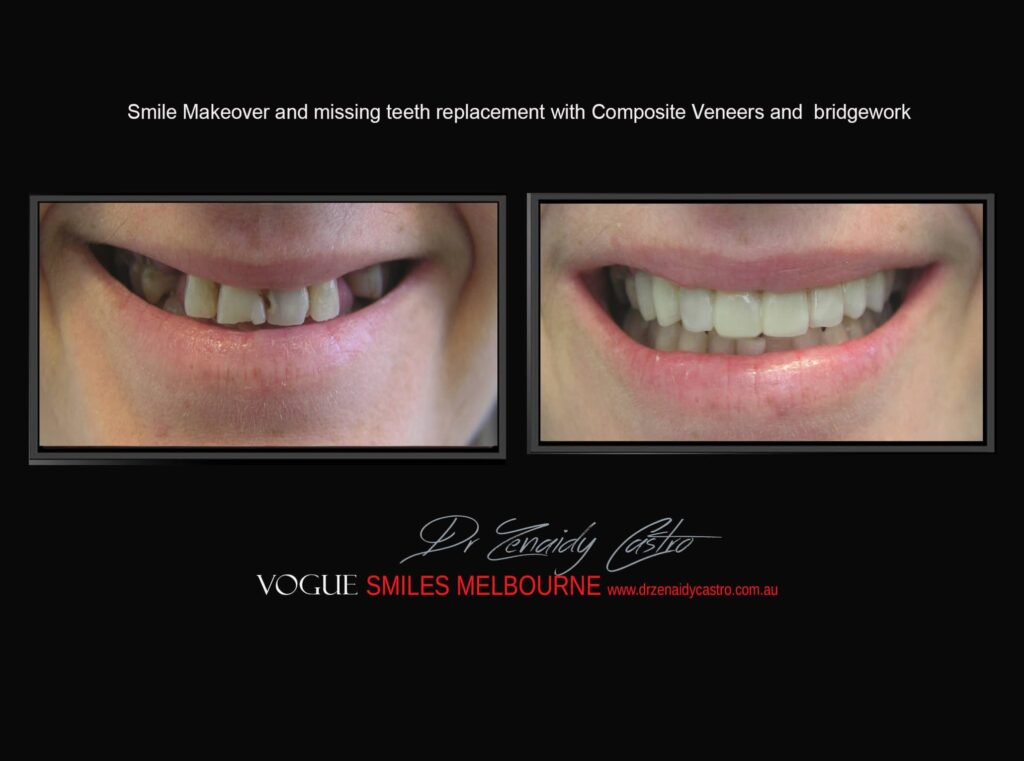 TRANSITIONAL-MAKEOVERS-MELBOURNE-Intermediate-Smile-Solutions-8.jpg
