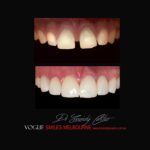 VOGUE-SMILES-COSMETIC-DENTISTRY-TREATMENT-100.jpg