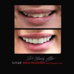 VOGUE-SMILES-COSMETIC-DENTISTRY-TREATMENT-102.jpg