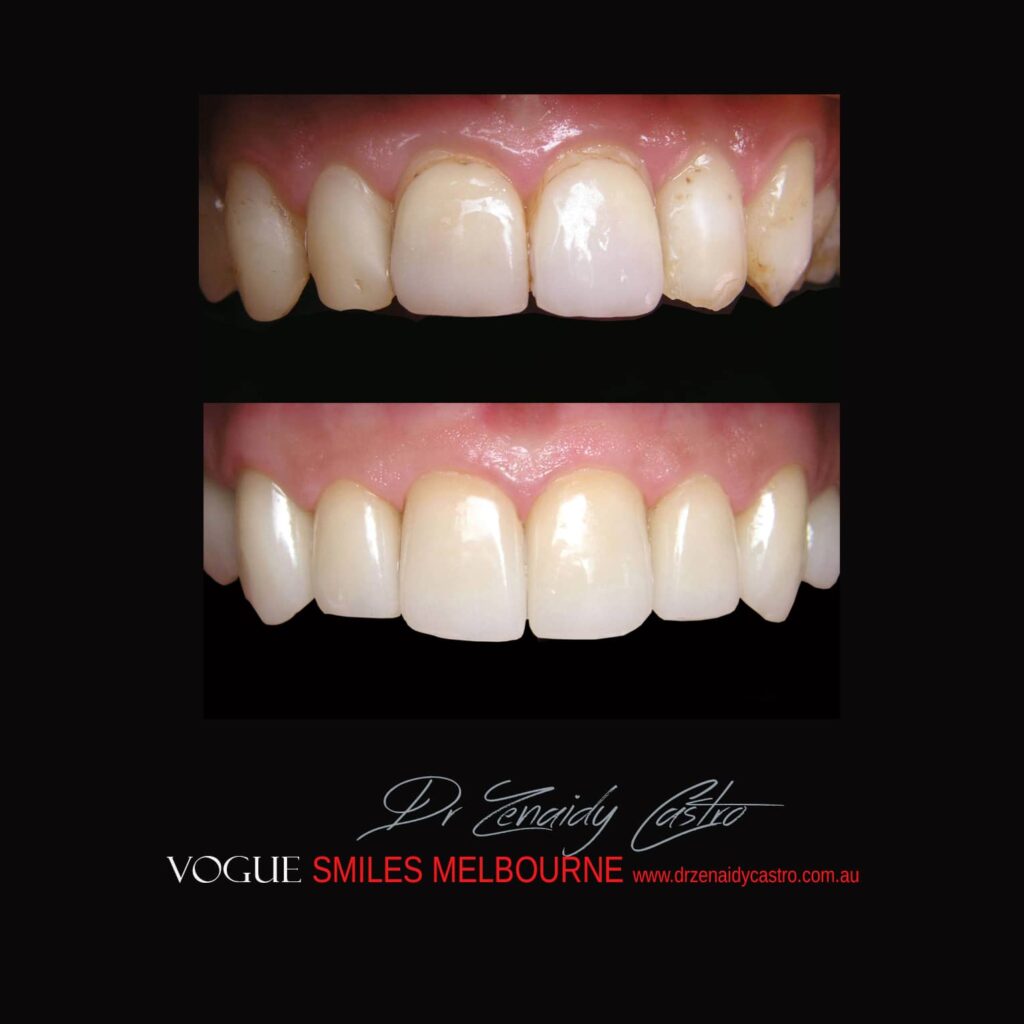 VOGUE SMILES COSMETIC DENTISTRY Treatment Gallery - Leading Cosmetic Dentist in Melbourne CBD - VOGUE Smiles Melbourne