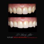 VOGUE SMILES MELBOURNE COSMETIC DENTISTRY B&A Before and After Smile Gallery photos -Top Cosmetic Dentist Melbourne