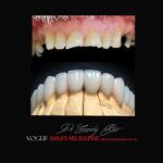 VOGUE SMILES MELBOURNE COSMETIC DENTISTRY B&A Before and After Smile Gallery photos -Top Cosmetic Dentist Melbourne