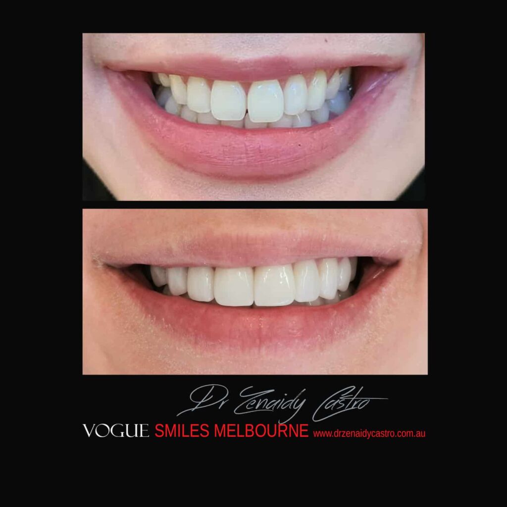 VOGUE SMILES COSMETIC DENTISTRY Treatment Gallery - Leading Cosmetic Dentist in Melbourne CBD - VOGUE Smiles Melbourne