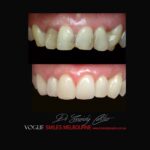 VOGUE SMILES MELBOURNE COSMETIC DENTISTRY B&A Before and After Smile Gallery photos -Top Cosmetic Dentist Melbourne