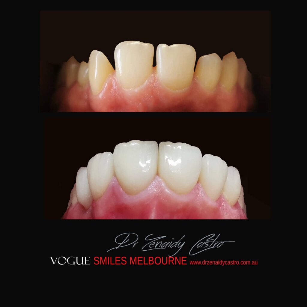 VOGUE SMILES COSMETIC DENTISTRY Treatment Gallery - Leading Cosmetic Dentist in Melbourne CBD - VOGUE Smiles Melbourne