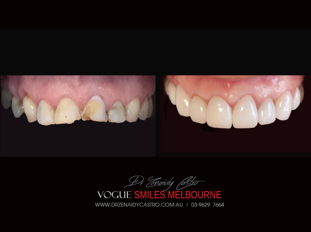 VOGUE SMILES MELBOURNE COSMETIC DENTISTRY B&A Before and After Smile Gallery photos -Top Cosmetic Dentist Melbourne