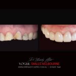 VOGUE SMILES MELBOURNE COSMETIC DENTISTRY B&A Before and After Smile Gallery photos -Top Cosmetic Dentist Melbourne