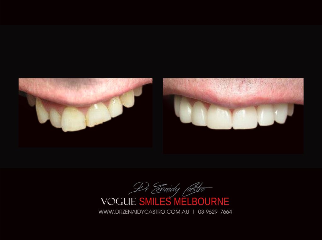 VOGUE SMILES COSMETIC DENTISTRY Treatment Gallery - Leading Cosmetic Dentist in Melbourne CBD - VOGUE Smiles Melbourne