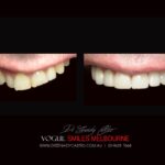 VOGUE SMILES COSMETIC DENTISTRY Treatment Gallery - Leading Cosmetic Dentist in Melbourne CBD - VOGUE Smiles Melbourne