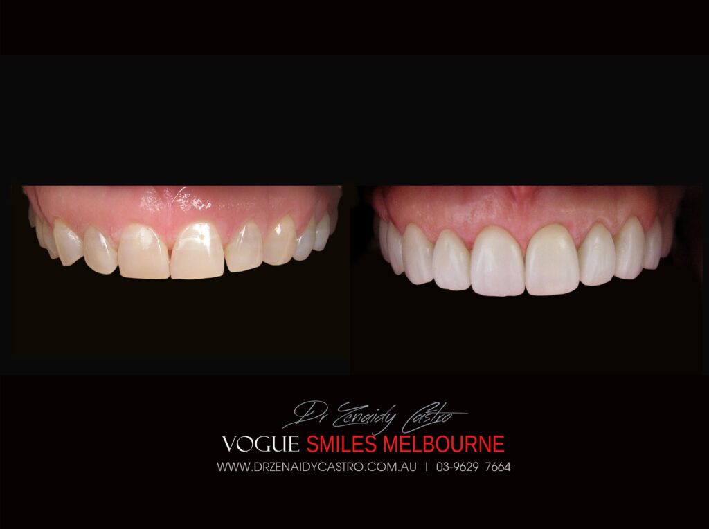 VOGUE SMILES MELBOURNE COSMETIC DENTISTRY B&A Before and After Smile Gallery photos -Top Cosmetic Dentist Melbourne