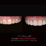 VOGUE SMILES MELBOURNE COSMETIC DENTISTRY B&A Before and After Smile Gallery photos -Top Cosmetic Dentist Melbourne