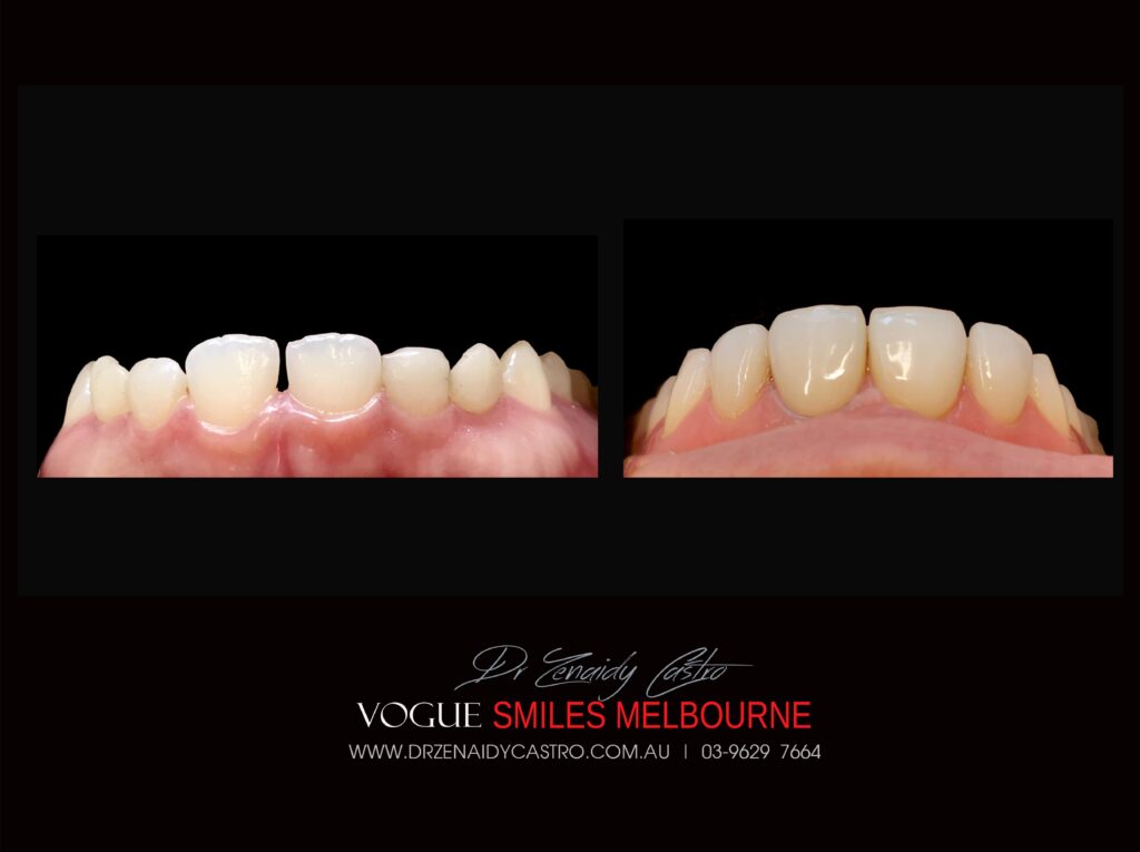 VOGUE-SMILES-COSMETIC-DENTISTRY-TREATMENT-115-scaled.jpg