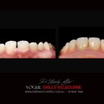 VOGUE-SMILES-COSMETIC-DENTISTRY-TREATMENT-115-scaled.jpg