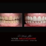 VOGUE SMILES MELBOURNE COSMETIC DENTISTRY B&A Before and After Smile Gallery photos -Top Cosmetic Dentist Melbourne