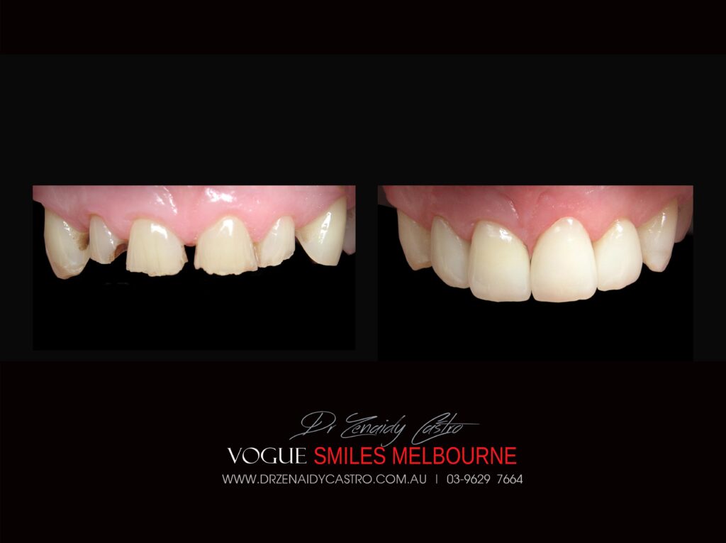 VOGUE-SMILES-COSMETIC-DENTISTRY-TREATMENT-117-scaled.jpg