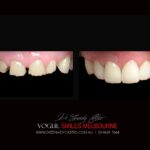 VOGUE-SMILES-COSMETIC-DENTISTRY-TREATMENT-117-scaled.jpg