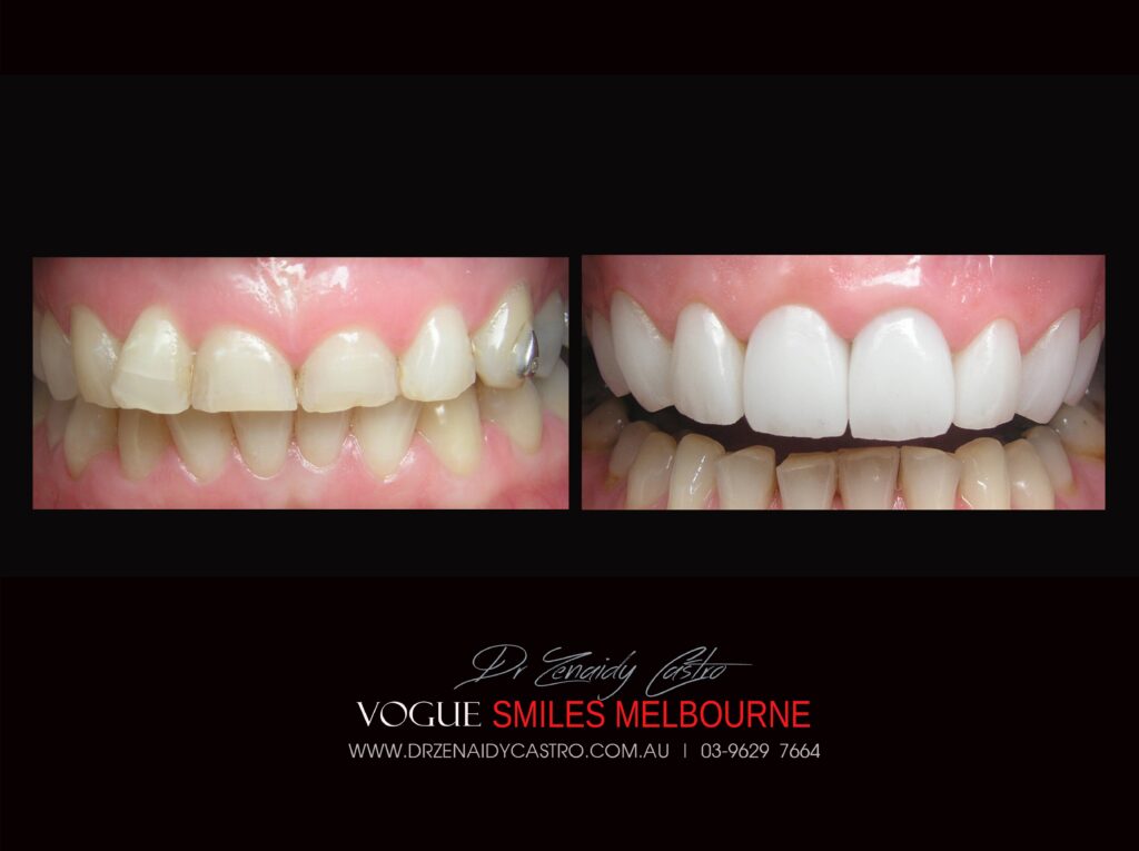 VOGUE SMILES MELBOURNE COSMETIC DENTISTRY B&A Before and After Smile Gallery photos -Top Cosmetic Dentist Melbourne