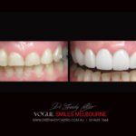 VOGUE SMILES MELBOURNE COSMETIC DENTISTRY B&A Before and After Smile Gallery photos -Top Cosmetic Dentist Melbourne