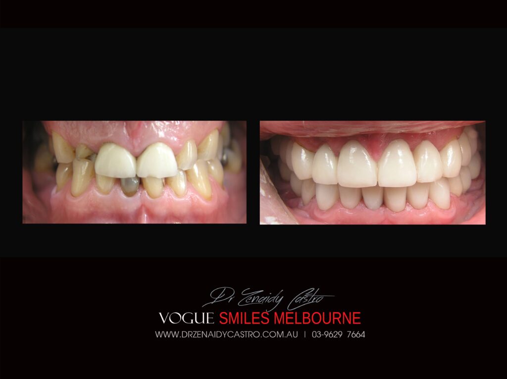 VOGUE-SMILES-COSMETIC-DENTISTRY-TREATMENT-119-scaled.jpg