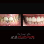 VOGUE-SMILES-COSMETIC-DENTISTRY-TREATMENT-119-scaled.jpg