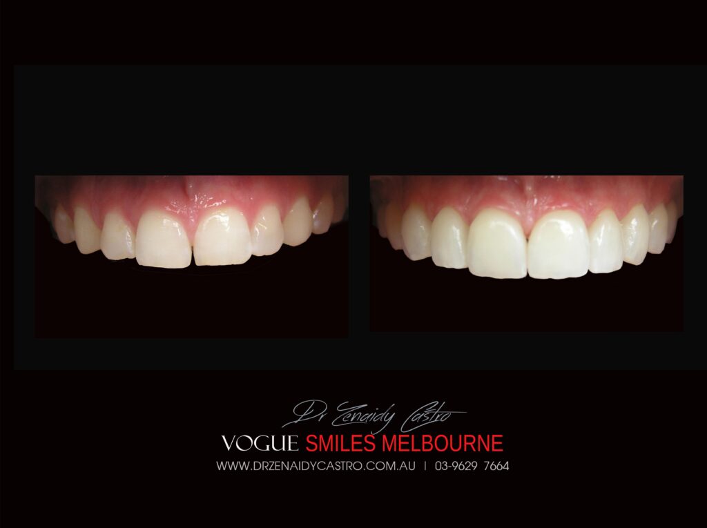 VOGUE SMILES MELBOURNE COSMETIC DENTISTRY B&A Before and After Smile Gallery photos -Top Cosmetic Dentist Melbourne