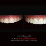 VOGUE SMILES MELBOURNE COSMETIC DENTISTRY B&A Before and After Smile Gallery photos -Top Cosmetic Dentist Melbourne