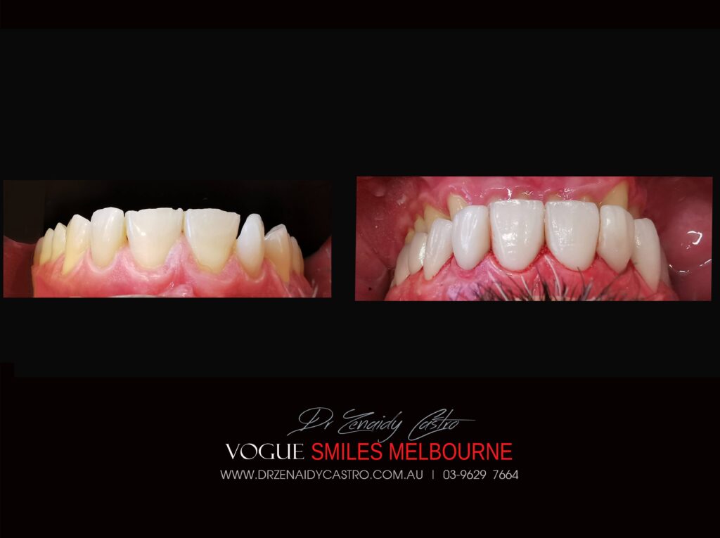 VOGUE-SMILES-COSMETIC-DENTISTRY-TREATMENT-121-scaled.jpg