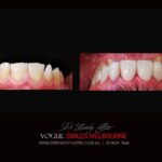 VOGUE-SMILES-COSMETIC-DENTISTRY-TREATMENT-121-scaled.jpg