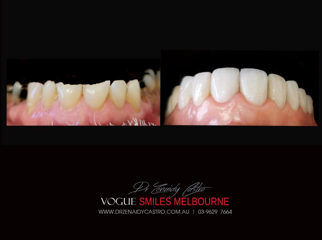 VOGUE SMILES MELBOURNE COSMETIC DENTISTRY B&A Before and After Smile Gallery photos -Top Cosmetic Dentist Melbourne