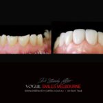 VOGUE SMILES MELBOURNE COSMETIC DENTISTRY B&A Before and After Smile Gallery photos -Top Cosmetic Dentist Melbourne