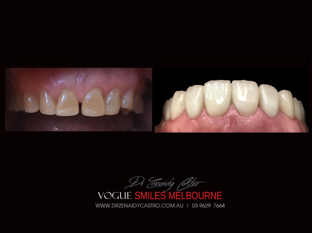 VOGUE-SMILES-COSMETIC-DENTISTRY-TREATMENT-123-scaled.jpg