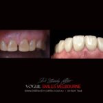 VOGUE-SMILES-COSMETIC-DENTISTRY-TREATMENT-123-scaled.jpg