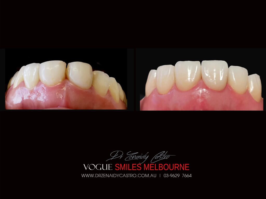 VOGUE SMILES MELBOURNE COSMETIC DENTISTRY B&A Before and After Smile Gallery photos -Top Cosmetic Dentist Melbourne