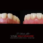 VOGUE SMILES MELBOURNE COSMETIC DENTISTRY B&A Before and After Smile Gallery photos -Top Cosmetic Dentist Melbourne
