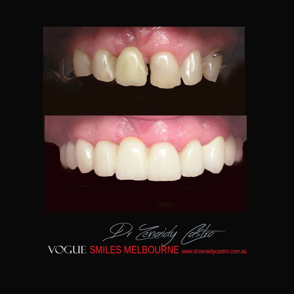 VOGUE SMILES MELBOURNE COSMETIC DENTISTRY B&A Before and After Smile Gallery photos -Top Cosmetic Dentist Melbourne