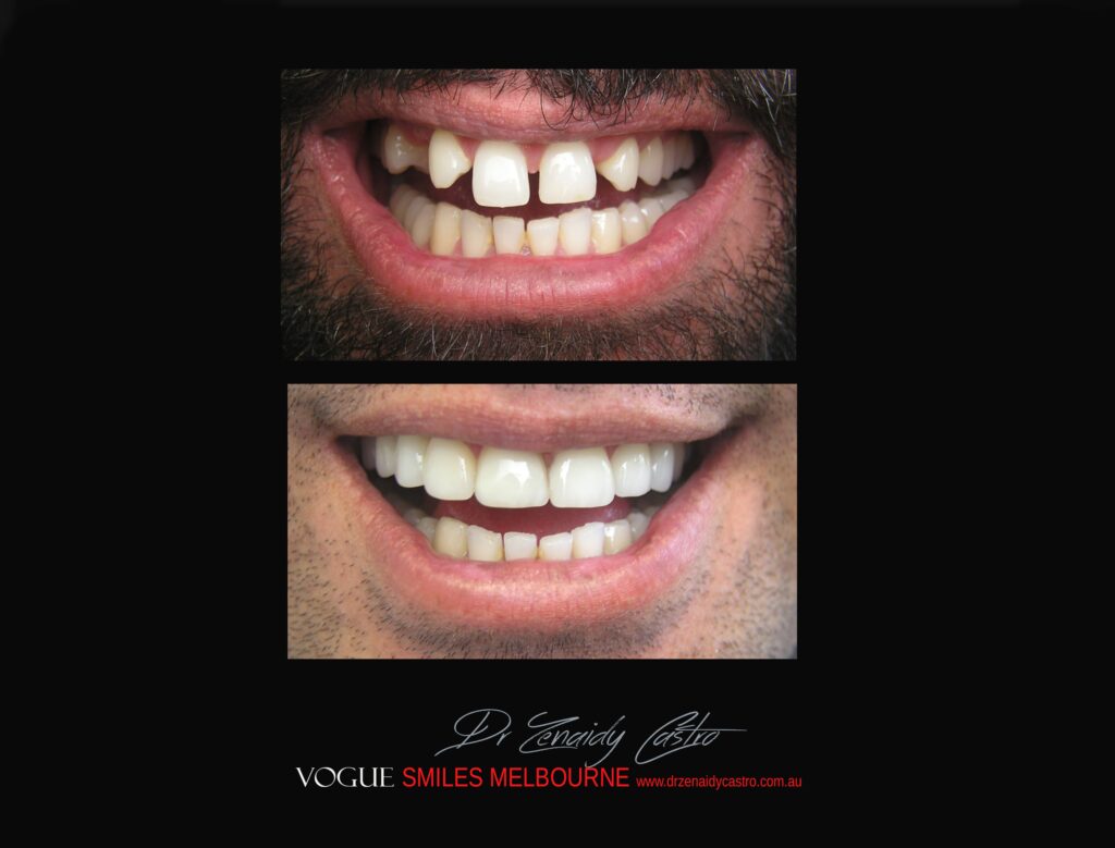 VOGUE-SMILES-COSMETIC-DENTISTRY-TREATMENT-127-scaled.jpg