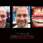 VOGUE-SMILES-COSMETIC-DENTISTRY-TREATMENT-13-scaled.jpg