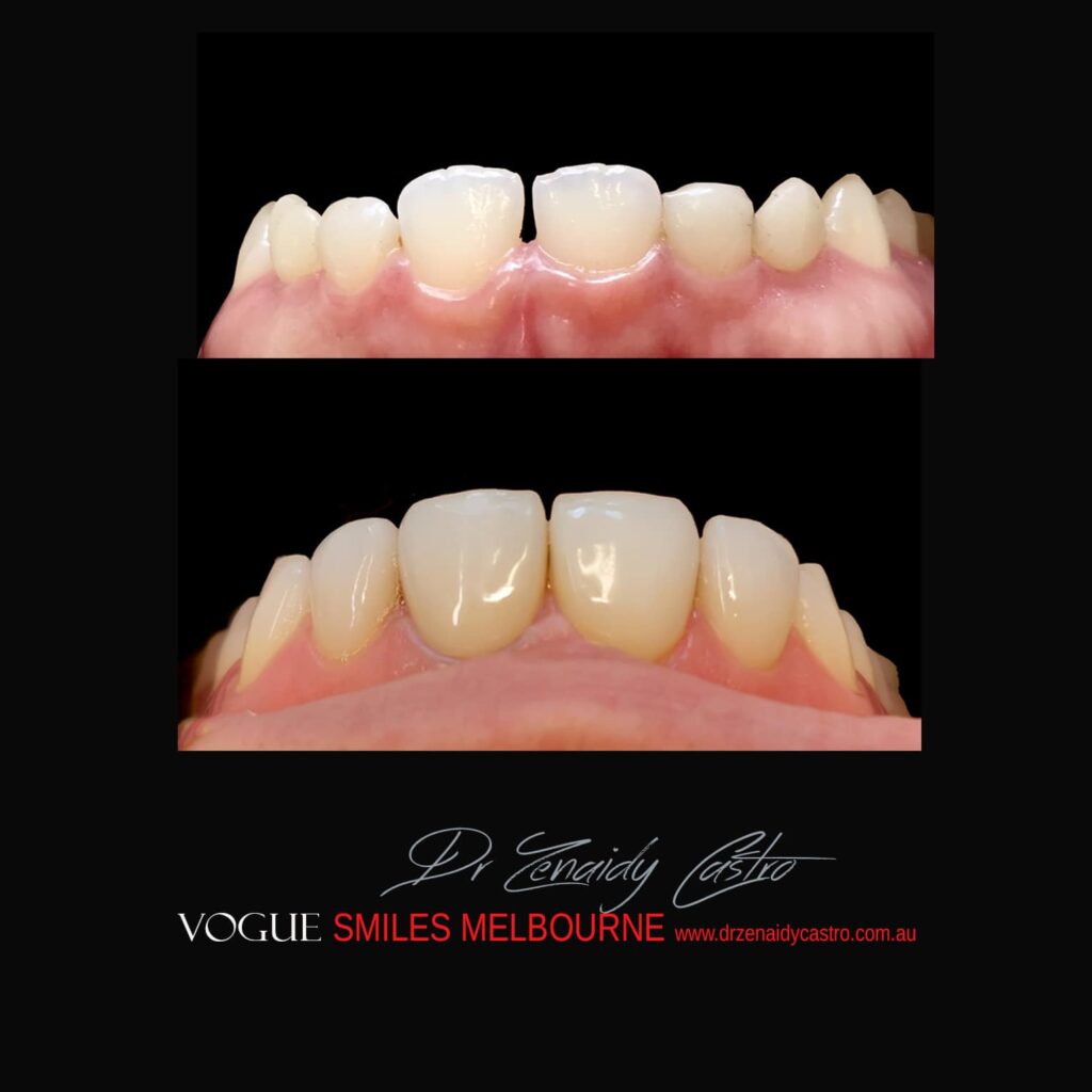 VOGUE SMILES MELBOURNE COSMETIC DENTISTRY B&A Before and After Smile Gallery photos -Top Cosmetic Dentist Melbourne