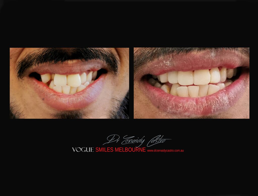 VOGUE-SMILES-COSMETIC-DENTISTRY-TREATMENT-135-scaled.jpg