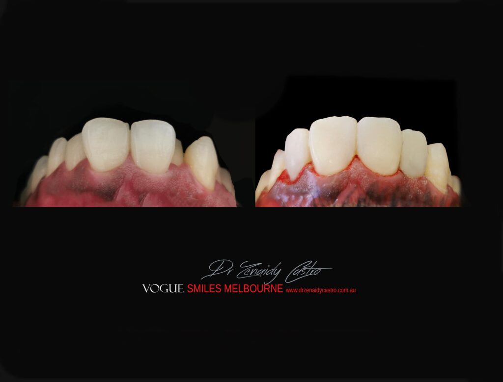 VOGUE SMILES MELBOURNE COSMETIC DENTISTRY B&A Before and After Smile Gallery photos -Top Cosmetic Dentist Melbourne