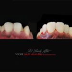 VOGUE SMILES MELBOURNE COSMETIC DENTISTRY B&A Before and After Smile Gallery photos -Top Cosmetic Dentist Melbourne